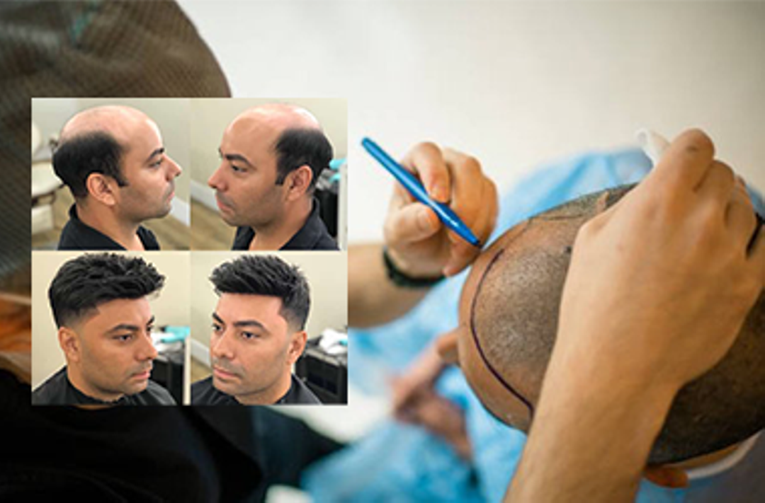 Exploring Hair Replacement: Surgical vs. Non-Surgical Options