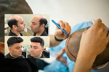 Hair Replacement