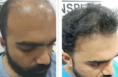 Hair Transplantation